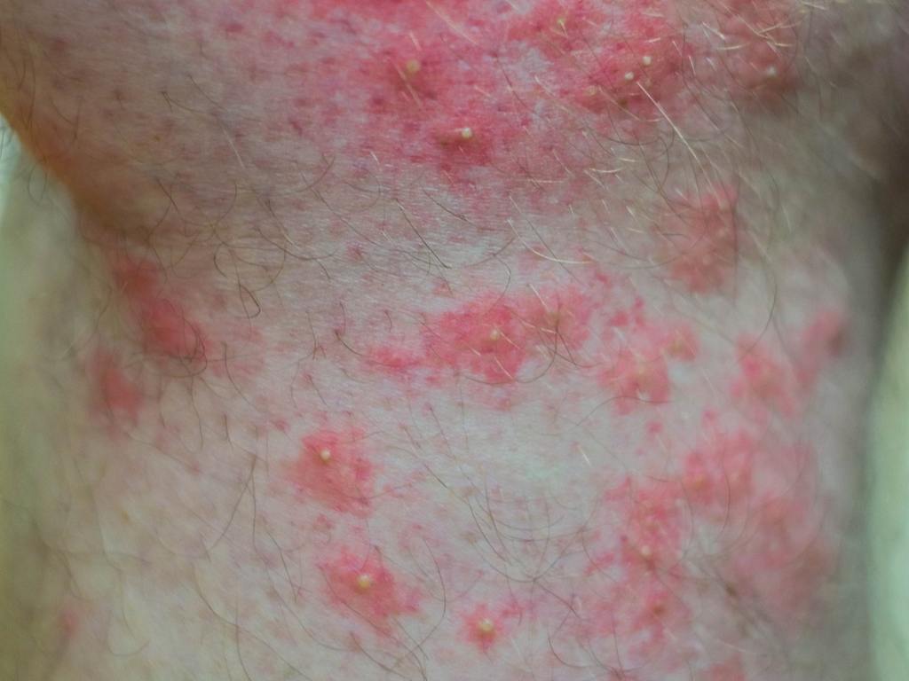 ​Fire Ant Bites: What Homeowners Should Know Before the Yard Becomes Unsafe cover